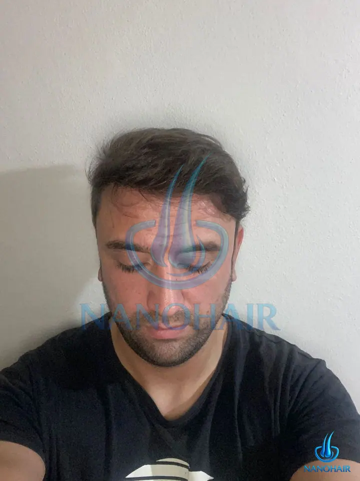 S*** Ö. sonrası